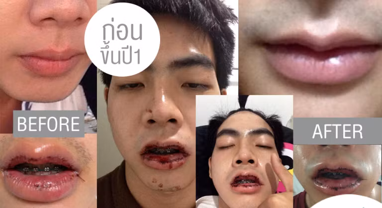 Để có đôi môi căng mọng, anh chàng này đã phẫu thuật độn môi và tiêm chất làm đầy.