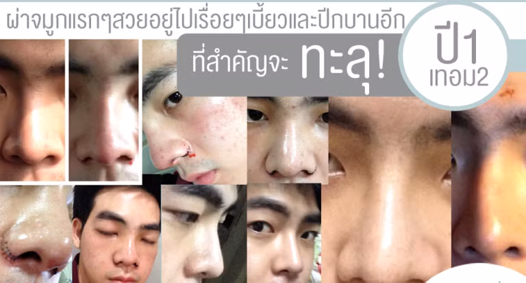 Những đau đớn chàng trai này phải chịu khi nâng mũi và cắt cánh mũi đề có một chiếc mũi thon, cao hoàn hảo.