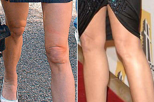 Phẫu thuật hút mỡ đầu gối. Theo một số chuyên gia, bộ phận mà phụ nữ ghét nhất trên cơ thể không phái bụng hay mông mà chính là đầu gối. Hầu hết phụ nữ tìm đến phẫu thuật hút mỡ ở đầu gối vì họ ghét bộ phần này, có lẽ do họ có thể dễ dàng nhìn thấy chúng trong gương trong khi mông và đùi lại khá khó quan sát.