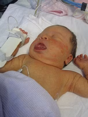 Đến tuần thứ 12, chiếc lưỡi phát triển tới mức Olivia không thể thở nổi. Bé phải nhập viện để phẫu thuật mở khí quản.