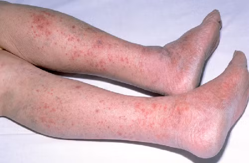 Viêm não cấp tính thường kéo dài 1- 3 tuần, nhưng sự hồi phục rất chậm. Mặc dù đã có thuốc kháng virus nhưng thuốc chỉ có tác dụng với một số loại virus chứ không phải kháng tất cả các virus. Để phòng bệnh, cần tránh để muỗi đốt bằng cách dùng nhang xua muỗi, phun thuốc muỗi định kỳ, mặc quần áo dài, ngủ màn... Đối với bệnh viêm não Nhật Bản B đã có vắc xin thì nên cho trẻ tiêm phòng bệnh.