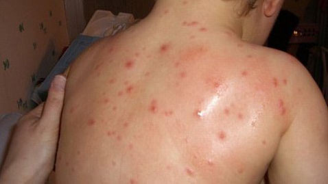 Cùng với dịch sởi, bệnh tay chân miệng chuẩn bị bước vào đỉnh dịch, đe dọa cộng đồng. Bệnh thủy đậu chưa có số thống kê cụ thể, nhưng cũng đang gia tăng tại TP.Hồ Chí Minh, Bà Rịa - Vũng Tàu, Long An, Bình Dương… Ngoài ra, tại các nước giáp với Việt Nam đang gia tăng số ca mắc TCM như Trung Quốc tăng 1% so với cùng kỳ năm 2013, Singapore tăng 29%...