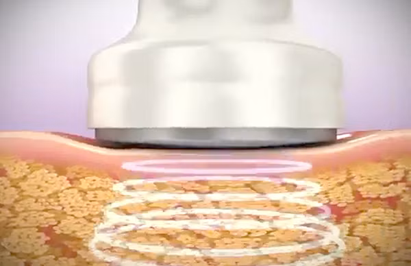 Khi đã hoàn thành việc đưa lượng mỡ thừa ra khỏi cơ thể, bác sĩ sẽ điều chỉnh lại năng lượng laser phù hợp tiến hành sắp xếp lại các tế bào collagen giúp da vùng điều trị không bị nhăn nheo chảy sệ.