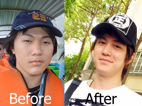 Chàng trai Jose Chung, người Trung Quốc đã cảm thấy không hài lòng với khuôn mặt của mình và đã có cuộc lột xác ngoạn mục sau khi quyết tâm phẫu thuật thẩm mỹ để sở hữu vẻ đẹp như mong muốn.