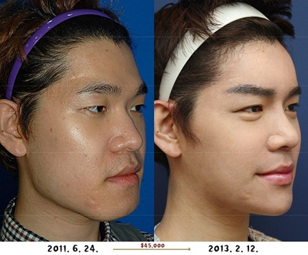 Cư dân mạng từng xôn xao về hình ảnh một chàng trai Hàn Quốc có nhan sắc bình thường đã trở thành hot boy nhờ phẫu thuật thẩm mĩ. Chàng trai này vốn sở hữu một khuôn mặt to, cằm bạnh, mắt một mí, mũi thấp.