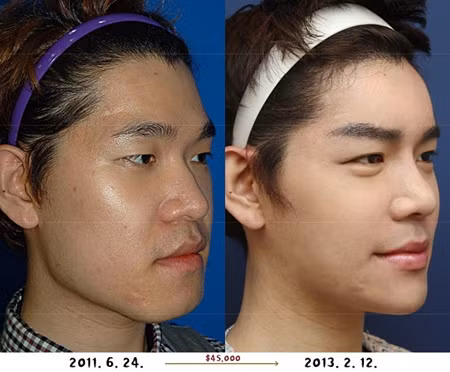 Cư dân mạng từng xôn xao về hình ảnh một chàng trai Hàn Quốc có nhan sắc bình thường đã trở thành hot boy nhờ phẫu thuật thẩm mĩ. Chàng trai này vốn sở hữu một khuôn mặt to, cằm bạnh, mắt một mí, mũi thấp.