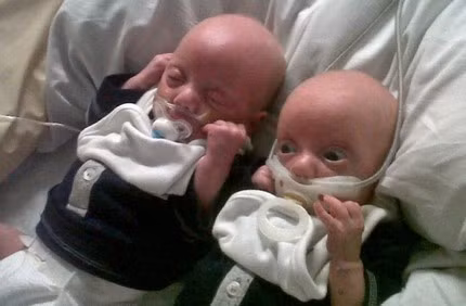 Trước đó, hồi tháng 1/2013, y tá của Bệnh viện Stafford (Anh) từng dùng băng dính dán chặt núm vú giả vào miệng bé trai sinh non, khiến dư luận nước này phẫn nộ. Nữ y tá này đã bị đình chỉ công tác ngay sau đó để phục vụ công tác điều tra.