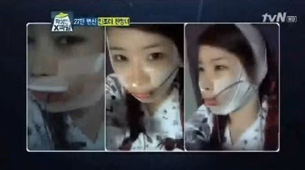 Tính đến thời điểm hện tại, cô nàng đã trải qua đến 27 lần phẫu thuật thẩm mỹ với 3 lần làm mũi, tiêm botulinum toxin chống lão hoá da mặt đến 4 lần, chưa kể đến những lần thẩm mỹ cắt mí mắt, gọt cằm, chỉnh sửa xương mặt...