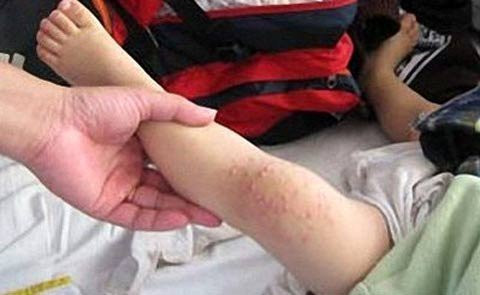 Nguy cơ nhiễm khuẩn da lan tràn. Nên nhớ da là cơ quan chính yếu gây bệnh của vi rút. Chúng sẽ xâm nhập qua da và gây bệnh ngay tại đây. Ổ chứa vi rút chính là các bọng nước. Chúng chức vô vàn các thế hệ vi rút nhân bản khác nhau và tụ hợp lại trong các bọng nước này. Da tại các vùng này bị tổn thương nghiêm trọng, mất chức năng che phủ và tự vệ trước vi khuẩn.