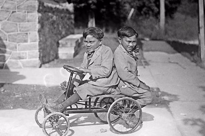 Cặp song sinh Lucio và Simplicio Godina sinh ra tại Samar ở Philippines, sinh năm 1908. Cặp đôi này bị dính liền phần sụn dưới lưng và mông, tuy nhiên Lucio bị viêm phổi năm 1936 và sau đó qua đời, một cuộc phẫu thuật khẩn cấp đã được thực hiện để tách rời cặp đôi, tuy nhiên, 12 ngày sau đó Simplicio Godina đã qua đời 12 ngày sau đó do viêm màng não.