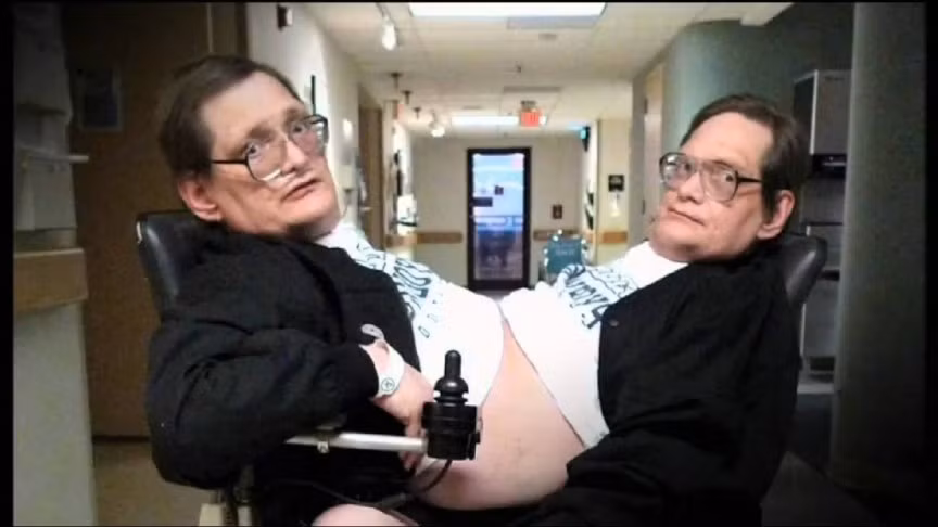 Ronnie và Donnie Galyon, sinh ngày 28//10/1951 tại Mỹ, hiện đang giữ kỷ lục cặp đôi song sinh dính liền già nhất thế giới. Họ bị dính liền nhau từ phần xương ức, có chung một bộ phận sinh dục và một số nội tạng quan trọng, vì thế lúc mới chào đời, các bác sĩ đã không thể phẫu thuật tách rời cặp song sinh này. Đến năm nay, cặp song sinh này đã 63 tuổi, từ năm 2009 họ đã về hưu và được chăm sóc y tế liên tục.