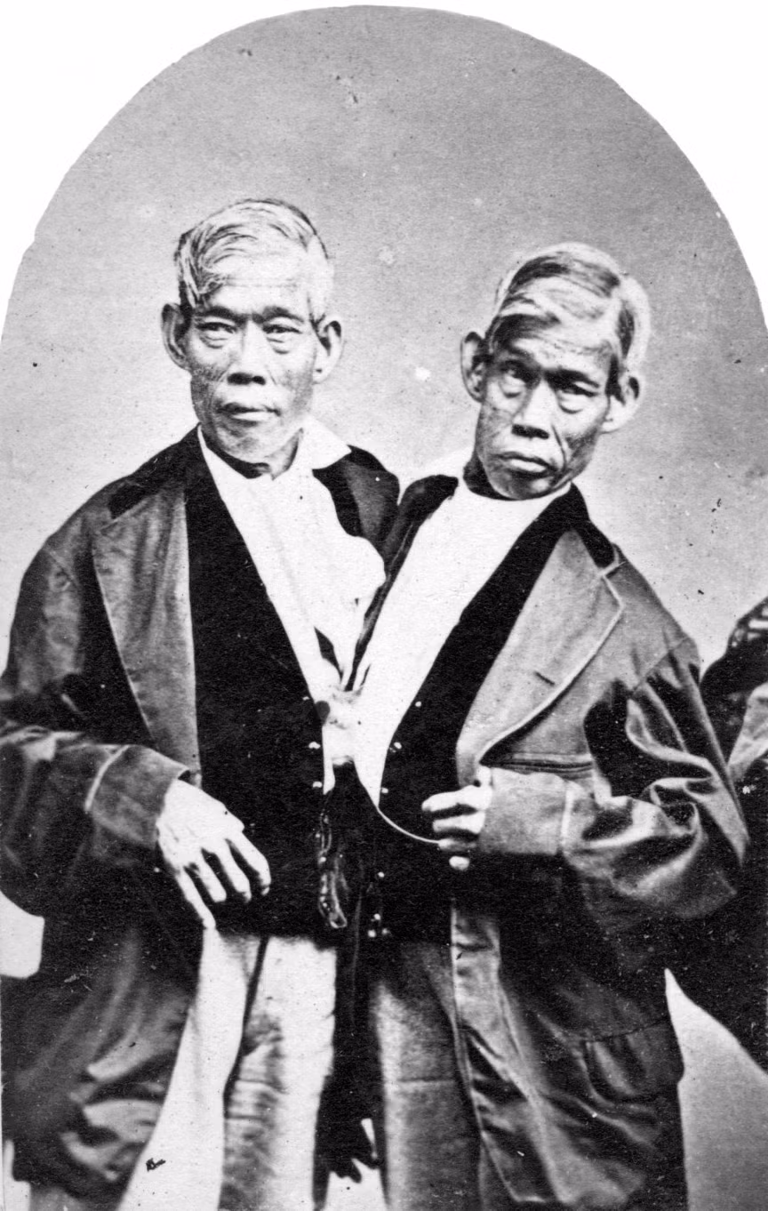 Chang và Eng Bunker (thọ 62 tuổi). Nổi tiếng nhất trong lịch sử các cặp song sinh dính liền là anh em Chang và Eng Bunker (Thái Lan), sinh năm 1811, dính liền nhau ở phần gan và ngực dưới. Họ đi lưu diễn ở nước ngoài từ năm 17 tuổi theo lời mời của một ông bầu người Mỹ, từng gặp gỡ các thành viên trong hoàng gia Anh. Ngày 17/1/1874, Eng thức giấc với cảm giác lạ; nhìn sang người anh, ông nhận ra Chang đã chết. Vài giờ sau đó, Eng cũng qua đời. Các bác sĩ khám nghiệm tử thi nhận thấy Chang chết vì tắc mạch máu não; họ cho rằng Eng chết vì sợ.