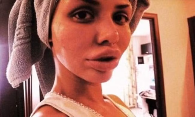 Đôi môi biến dạng, sưng vù vì bơm silicon lỏng. Để có đôi môi gợi cảm nhiều người đẹp đã chọn cách bơm silicone vào môi, tuy nhiên hiệu quả lại không được như mong muốn. Không chỉ bị sưng môi, nhiều người sau khi bơm môi còn bị lở loét, biến dạng và đau đớn.