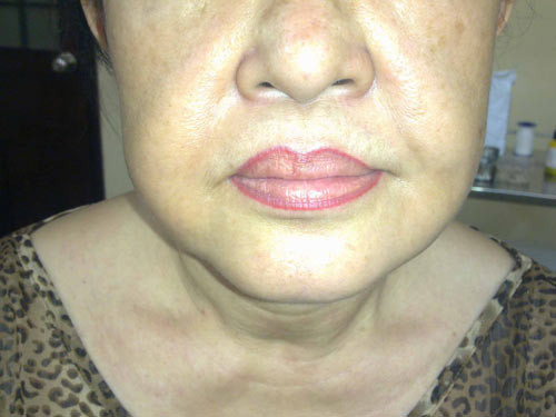 Mặt biến dạng vì bơm silicon. Tin tưởng vào quảng cáo "đẹp ngay tức thì", nhiều phụ nữ đã phải mang khuôn mặt lợn cợn những khối silicone đông cứng đến BV cầu cứu BS hoặc phải nhập viện cấp cứu vì silicone tạo phản ứng viêm, sưng tấy.