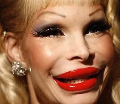 Thậm chí, đôi môi còn bị dày lên quá khổ so với khuôn mặt.