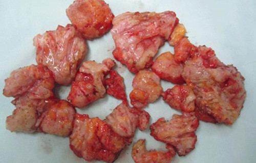 Qúy ông tử vong vì độn mông bằng silicon lỏng. Một quý ông Việt gặp tai biến dẫn đến tử vong do ham muốn làm đẹp với silicon. Bệnh viện Cấp cứu Trưng Vương, TPHCM đã tiếp nhận một trường hợp khác cũng bị tử vong do tự ý bơm silicon. Nạn nhân tên là T.Q.T - 21 tuổi, trú tại Tiền Giang đã được đưa đến cấp cứu ở BV Trưng Vương, TP HCM với triệu chứng suy hô hấp nặng.