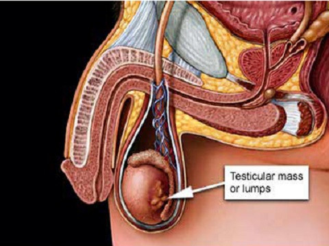 Những dấu hiệu khác lạ ở tinh hoàn cũng là một trong những biểu hiện của bệnh ung thư tinh hoàn. Đừng chủ quan, hãy đi khám bệnh nếu bạn thấy nó không ổn.