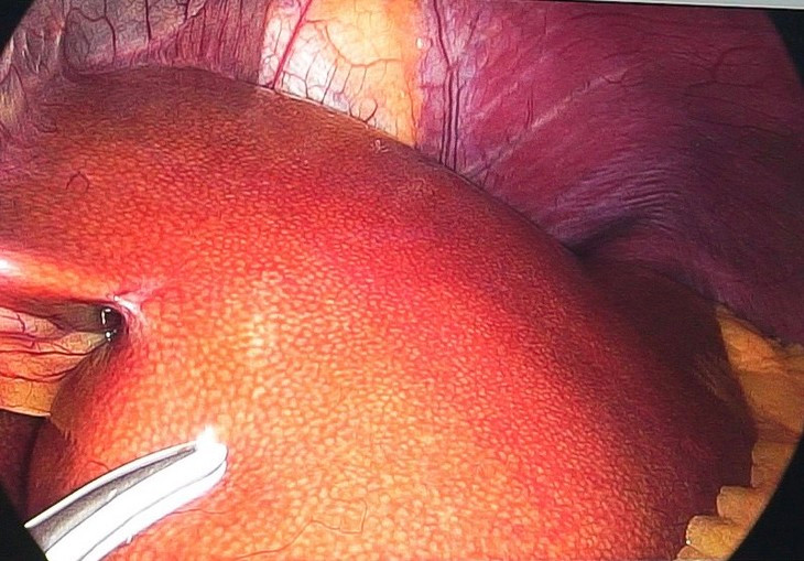 Hình ảnh bệnh nhân bị gan trắng vì đầy mỡ