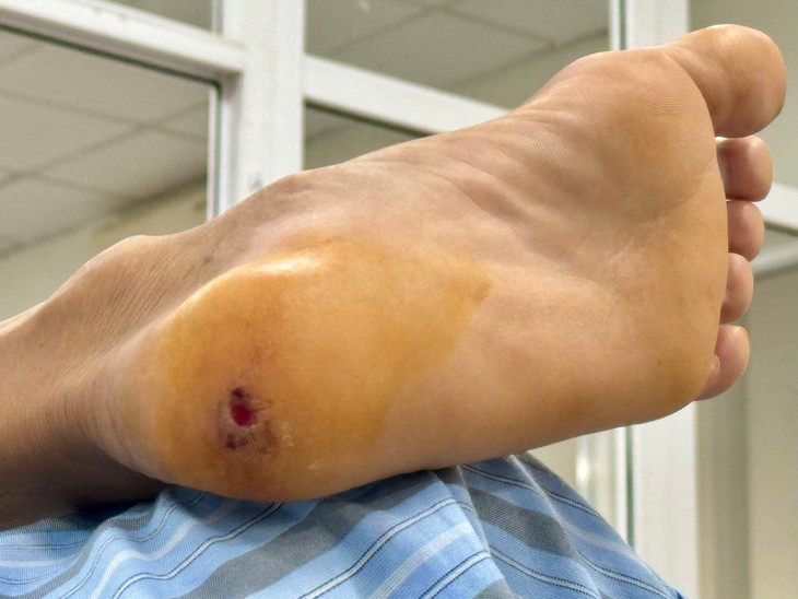 Mắc uốn ván từ vết gai đâm - Ảnh BVCC