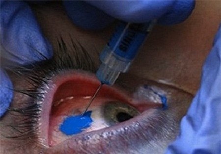 Với sự nhạy cảm vốn có của nhãn cầu mắt vậy nên người thực hiện thao tác xăm mắt phải cực kỳ chuyên nghiệp và có kinh nghiệm, vững tay mới có thể thực hiện được kiểu xăm này.