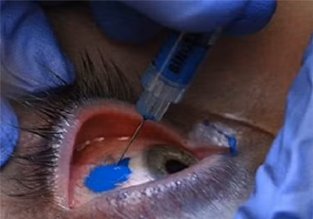 Với sự nhạy cảm vốn có của nhãn cầu mắt vậy nên người thực hiện thao tác xăm mắt phải cực kỳ chuyên nghiệp và có kinh nghiệm, vững tay mới có thể thực hiện được kiểu xăm này.