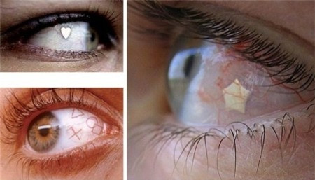 Không những xăm tròng mắt, các dân chơi còn gắn trang sức kim loại vào mắt để làm đẹp khác người.