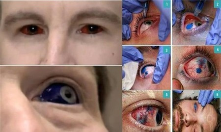 Khi thực hiện xăm tròng mắt, người được xăm sẽ phải trải qua một cơn đau đớn không nhỏ, không chỉ trong lúc xăm mà còn cả một quãng thời gian dài sau khi xăm xong mới có thể hoàn toàn bình phục.