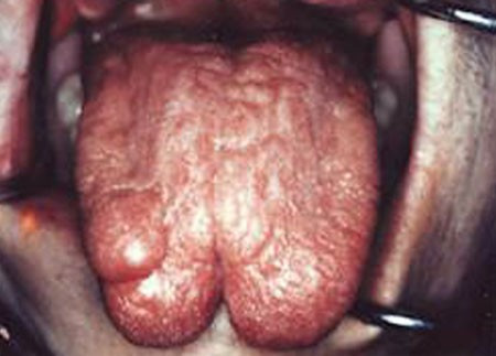 Có những người chơi tắt là dùng dao mổ xẻ đôi lưỡi, không bấm khuyên. Khi chảy nhiều máu quá thì dùng kim loại nung đỏ gí vào để cầm máu.