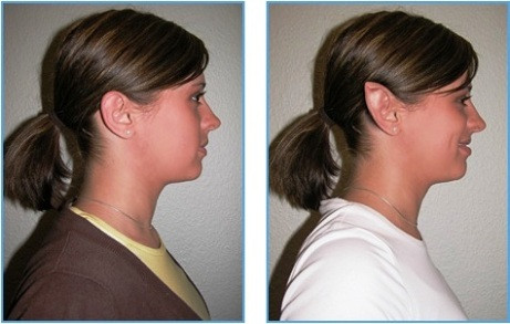 Bác sĩ phẫu thuật sẽ cắt các sụn và chuyển nó sang vị trí khác để tạo hình tai nhọn.