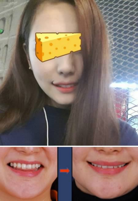 Ngoài việc phẫu thuật để tạo bọng mắt thì phẫu thuật tạo miệng ‘giả cười’ cũng đang lên ngôi ở xứ sở kim chi. Các bác sĩ sẽ cắt khóe miệng của bạn, rồi ‘tái tạo’ lại để khóe miệng luôn cong lên, như bạn đang mỉm cười vậy.