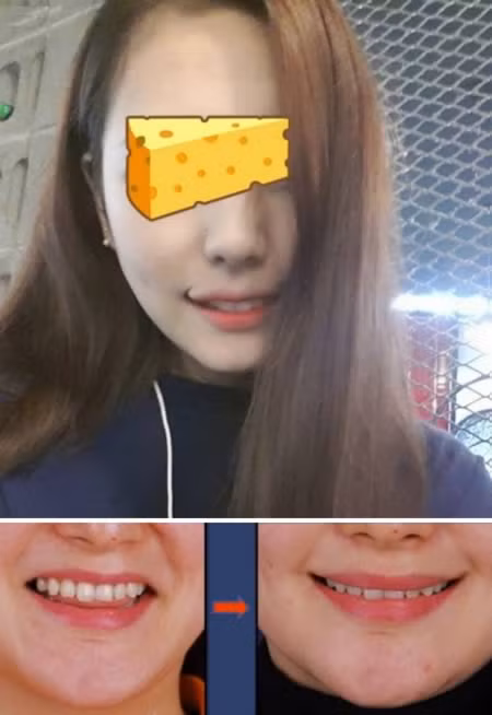 Ngoài việc phẫu thuật để tạo bọng mắt thì phẫu thuật tạo miệng ‘giả cười’ cũng đang lên ngôi ở xứ sở kim chi. Các bác sĩ sẽ cắt khóe miệng của bạn, rồi ‘tái tạo’ lại để khóe miệng luôn cong lên, như bạn đang mỉm cười vậy.