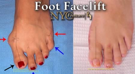 Thay đổi diện mạo bàn chân: phẫu thuật bàn chân đang trở thành xu hướng thịnh hành, như làm ngắn chân và loại bỏ mỡ thừa đã mang lại 45 triệu USD lợi nhuận. Ở New York (Mỹ), nhiều phụ nữ phẫu thuật chân để có thể đi vừa giày cao gót và các loại giày nhỏ gọn khác. Tuy nhiên, một số bác sỹ cho rằng phẫu thuật như vậy không hợp với y đức vì nó có thể có tác dụng phụ, trong đó bao gồm biến dạng ngón chân nếu phẫu thuật không đúng.