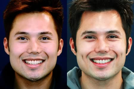 Má lúm đồng tiền là một vết lõm nhỏ ở trên má xuất hiện khi cười. Đó là một đặc điểm bẩm sinh và có tính chất di truyền trội. Hiện nay, phái đẹp, thậm chí là nhiều trường hợp phái mạnh cũng ưa chuộng loại hình làm đẹp bằng cách phẫu thuật tạo má lúm đồng tiền. Tuy nhiên, má lúm đồng tiền "nhân tạo" sẽ hiện diện ngay cả lúc không cười và có thể tiêu tan sau một vài năm.