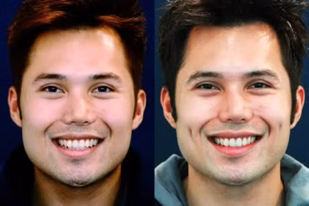 Má lúm đồng tiền là một vết lõm nhỏ ở trên má xuất hiện khi cười. Đó là một đặc điểm bẩm sinh và có tính chất di truyền trội. Hiện nay, phái đẹp, thậm chí là nhiều trường hợp phái mạnh cũng ưa chuộng loại hình làm đẹp bằng cách phẫu thuật tạo má lúm đồng tiền. Tuy nhiên, má lúm đồng tiền "nhân tạo" sẽ hiện diện ngay cả lúc không cười và có thể tiêu tan sau một vài năm.