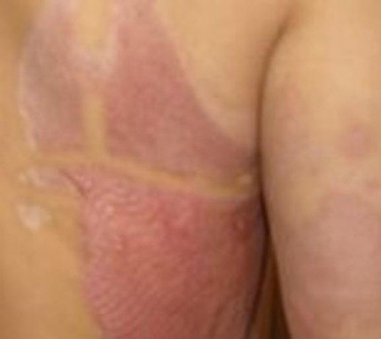 Những mảng da bị tấy đỏ như chín khi dị ứng kem tắm trắng.