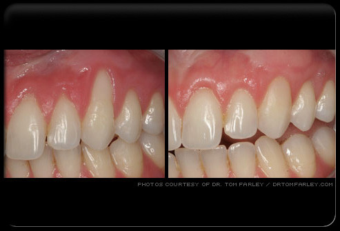 Ghép nướu cho răng bị tụt nướu. Bệnh nhân có thể được ghép tổ chức bù lại phần lợi bị tụt để che phủ chân răng và cổ răng, tránh mòn tổ chức cứng của răng, tổ chức ghép có thể lấy ở vùng hàm ếch hoặc vùng răng lân cận.