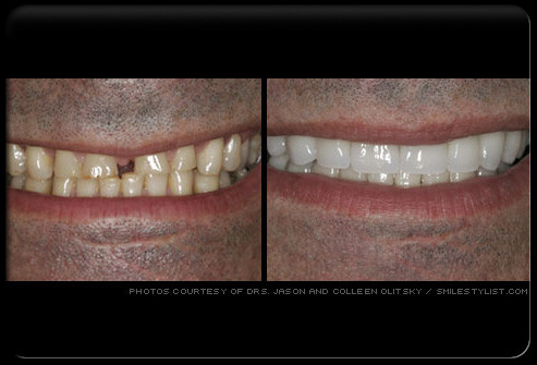 Dùng mặt dán veneer trên mặt ngoài các răng. Răng được mài mặt ngoài 0,3 mm, được khía các vạch trên mặt răng, sau đó được phủ mặt veneer sứ hoặc composite.