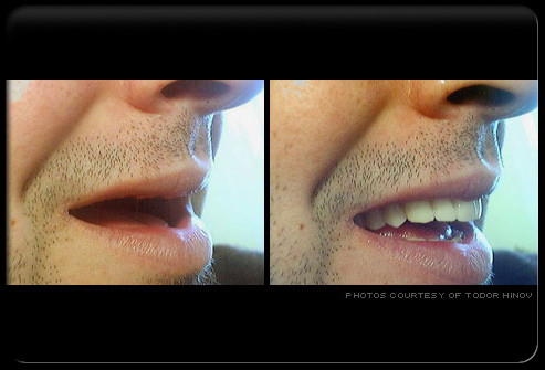 Răng giả có thể được sử dụng để tháo ra, lắp vào khi răng bị mất. Răng giả có thể được thay thế cho tất cả các răng bị mất hoặc dùng kết hợp với một số răng vẫn đang còn.