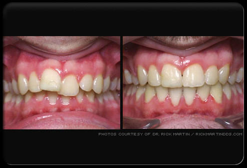 Cũng áp dụng phương pháp chỉnh răng thẩm mỹ, thủ thuật niềng răng có thể sửa răng bị khấp khểnh. Niềng răng có thể được sử dụng cho người lớn hoặc trẻ em bằng cách sử dụng áp lực lên răng trong một thời gian nhất định.