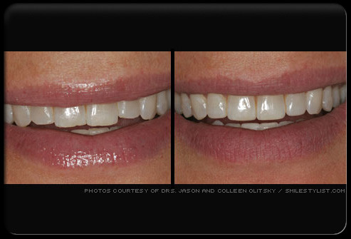 Làm răng sứ. Bác sĩ làm chụp bọc răng. Răng được mài nhỏ đi, mỗi mặt bị mài từ 0,5 đến 1,5 mm. Trường hợp răng mọc lệch, khấp khểnh nhiều thì cần mài nhiều hơn. Răng mài nhiều có thể cần được chữa tủy.