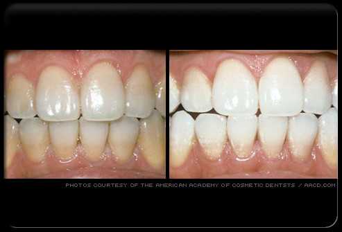 Tẩy trắng răng bằng thuốc kết hợp ánh sáng laser. Các răng sắp tẩy cũng được khám phát hiện và hàn kín lỗ sâu. Nha sĩ sẽ tẩy răng ngay tại phòng khám. Một tấm cao su mỏng sẽ được đục lỗ để các răng chui qua, tấm này có tác dụng bảo vệ lợi không tiếp xúc với thuốc. Thuốc tẩy răng được bôi lên mặt ngoài các răng, sau đó mặt răng được chiếu laser. Các phân tử thuốc bị ánh sáng kích thích sẽ ngấm vào răng nhanh hơn. Sau 60 đến 90 phút, răng bạn sẽ trắng ra.