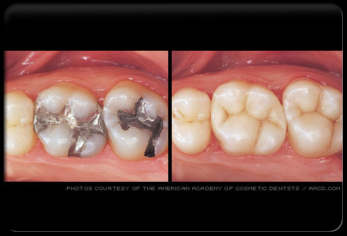 Hàn răng. Hàn răng bằng Amangam ( Một ợp kim gồm Bạc, đồng, thủy ngân và một vài hợp kim khác ). Sau một thời gian, chất liệu này phải được thay thế bằng chất mới do tác động của axit trong nước bọt.