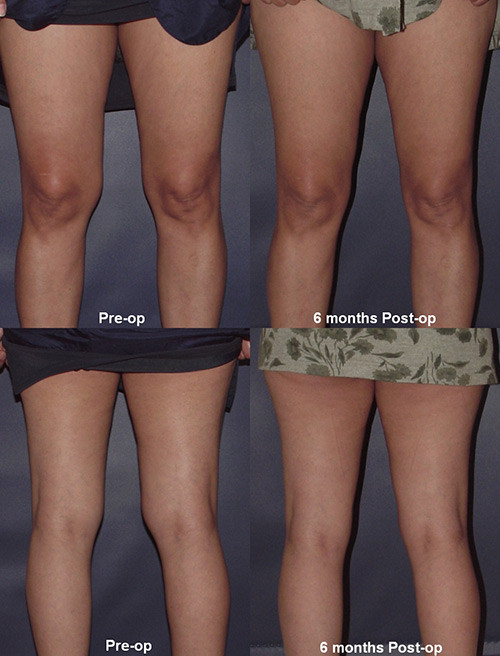 Phẫu thuật hút mỡ đầu gối. Theo 1 điều tra không chính thức, bộ phận thừa mỡ mà phụ nữ ghét nhất trên cơ thể họ không phải bụng, bắp tay hay mông, mà là...đầu gối. Bộ phận này thường bị lộ vẻ tròn trĩnh và rất dễ nhận ra khi phái đẹp diện váy ngắn hay những chiếc quần shorts quyến rũ, thời thượng. Vì vậy, nhiều người đã nhờ cậy tới phẫu thuật thẩm mỹ để loại bỏ đi phần chất béo thừa thãi này.