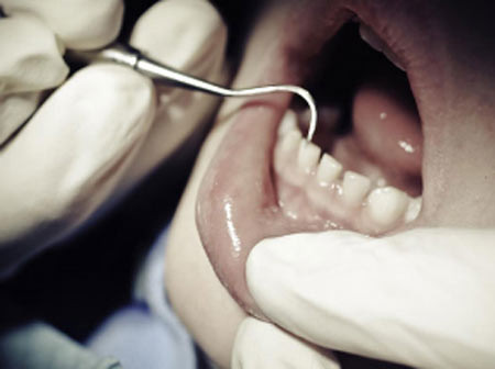 Đáng buồn là một khi nướu răng đã bị tổn hại thì rất khó lòng chữa khỏi. Lúc đó, người bệnh chỉ còn cách phải dùng kem đánh răng chống ê buốt... cả đời.