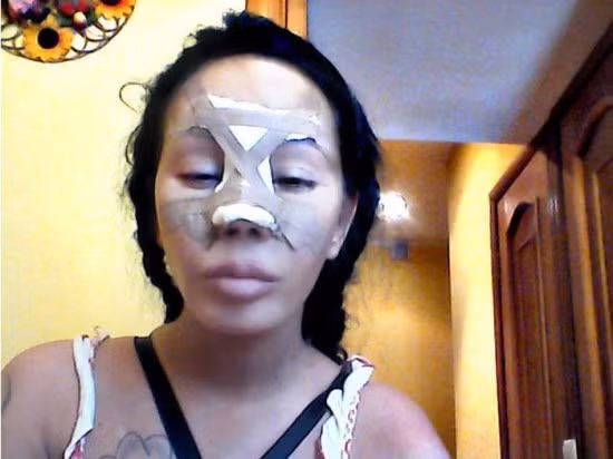 Hình ảnh Alyona sau khi nâng mũi.