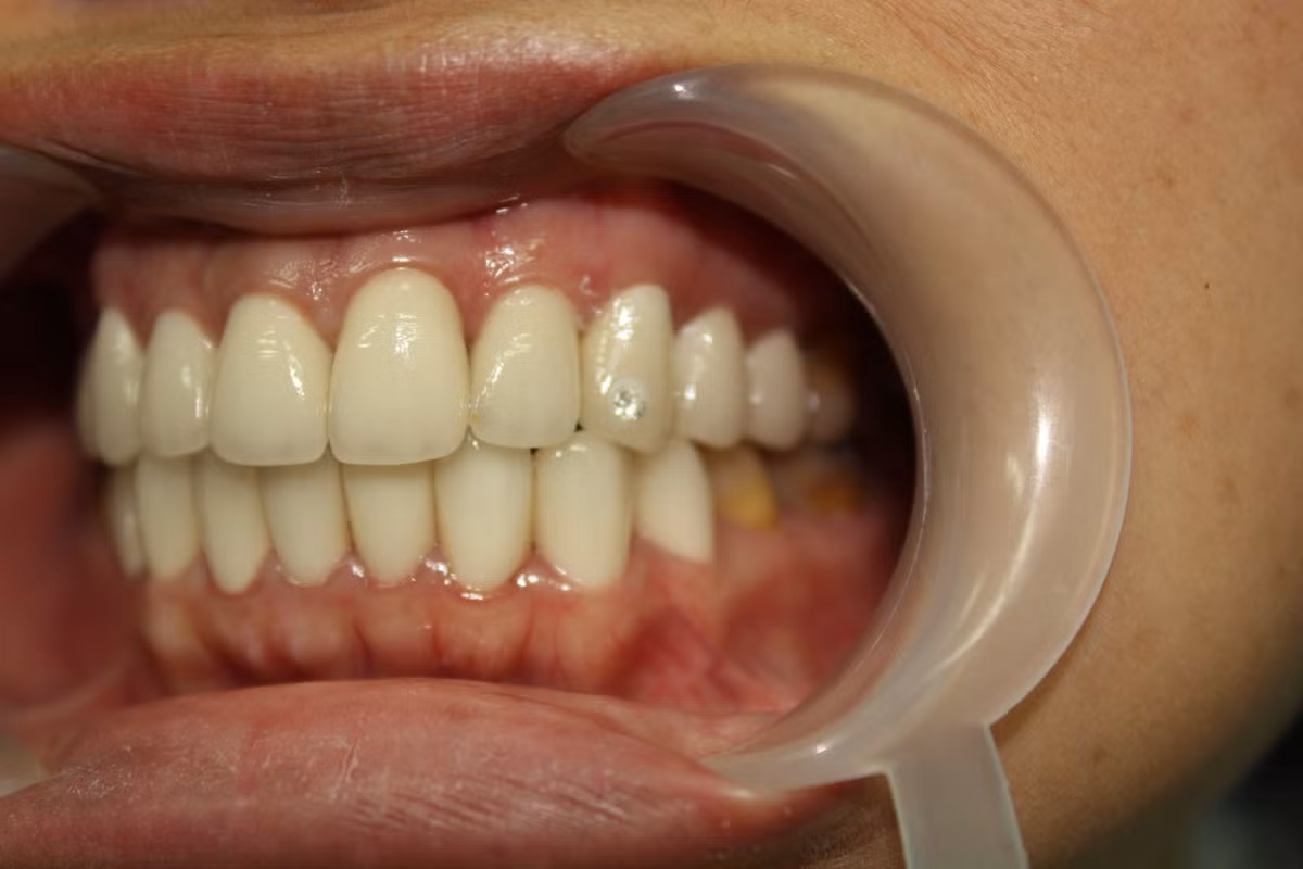 Nhiều trường hợp gắn đá vào răng “cười” chưa đủ 1 tuần đã có vấn đề như: Không ăn được đồ cứng, đến lúc đánh răng thì “đá đi, răng ở lại”. Nếu không tiếp tục gắn đá lại, lâu ngày thức ăn rơi vào vết khoan, ứ đọng, gây sâu răng.