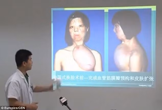 Nhóm phẫu thuật đã lấy vùng da đùi ghép lên ngực, sau đó sử dụng một bong bóng chứa đầy nước căng vùng da trên và nuôi trên ngực.