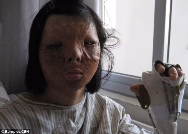 Khuôn mặt Xu Jianmei trước khi được cấy ghép, cô bé không thể cười và không dám soi gương với diện mạo kinh khủng sau tai nạn.
