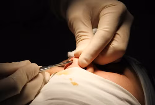 Bước 5: Rạch một đường ở rìa mũi của bạn để tạo khoảng trống đưa miếng sụn vào bên trong. Mọi thao tác lúc này cần phải thật tỉ mỉ và cẩn thận nhằm đạt được hiệu quả cao nhất cũng như không chạm vào các mạch máu quan trọng trên mũi.