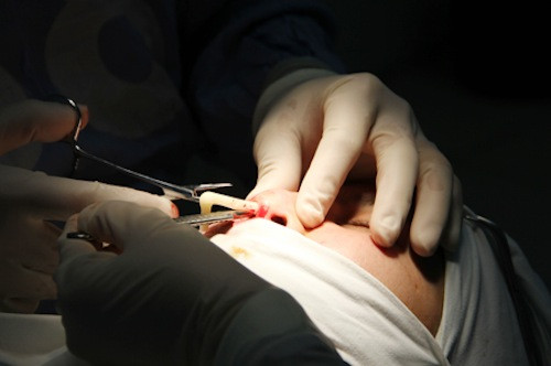 Bác sĩ đang đưa miếng sụn độn cho mũi cao hơn.